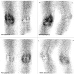 Obraz 2 i 3: W fazie miąższowej zwiększone i nierównomierne wysycenie radioznacznikiem w rzucie dalszej nasady prawej kości udowej i w rzucie bliższej nasady prawej piszczeli, stosunek P/L=2,16