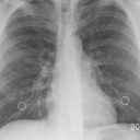 Rak płuca:  zabójca częściowo okiełznany