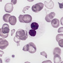 Zespoły  mielodysplastyczne