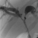 Endoluminalne RFA  – nowa metoda w paliatywnym leczeniu raka dróg żółciowych